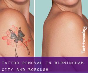 Tattoo Removal in Birmingham (City and Borough)