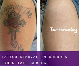 Tattoo Removal in Rhondda Cynon Taff (Borough)