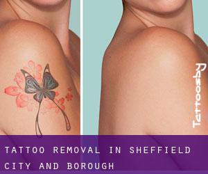 Tattoo Removal in Sheffield (City and Borough)