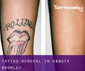 Tattoo Removal in Abbots Bromley