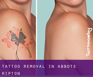 Tattoo Removal in Abbots Ripton
