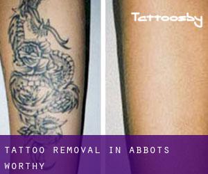 Tattoo Removal in Abbots Worthy