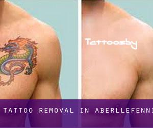 Tattoo Removal in Aberllefenni