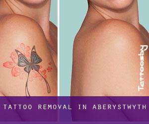 Tattoo Removal in Aberystwyth