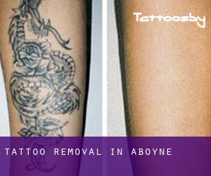 Tattoo Removal in Aboyne