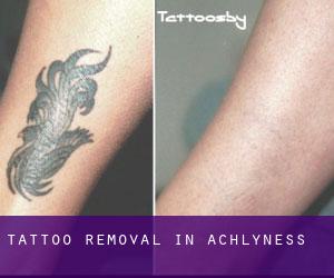 Tattoo Removal in Achlyness