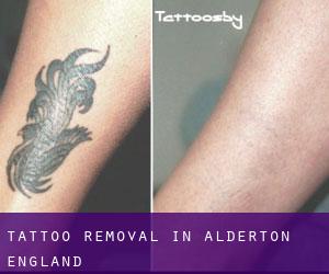 Tattoo Removal in Alderton (England)