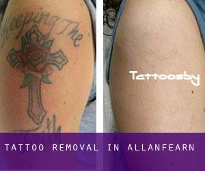 Tattoo Removal in Allanfearn