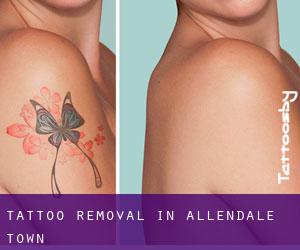Tattoo Removal in Allendale Town