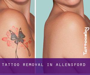Tattoo Removal in Allensford