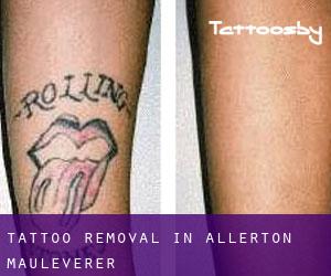 Tattoo Removal in Allerton Mauleverer