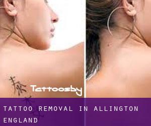 Tattoo Removal in Allington (England)