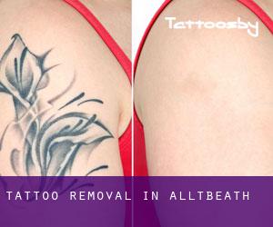 Tattoo Removal in Alltbeath