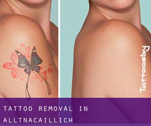 Tattoo Removal in Alltnacaillich