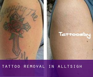 Tattoo Removal in Alltsigh