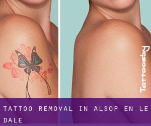 Tattoo Removal in Alsop en le Dale