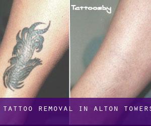 Tattoo Removal in Alton Towers