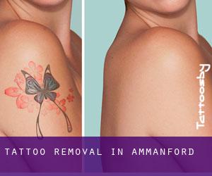 Tattoo Removal in Ammanford