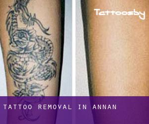 Tattoo Removal in Annan