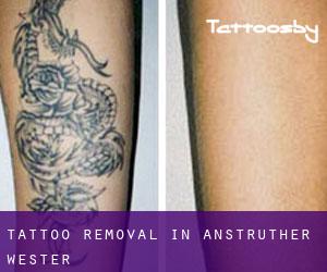 Tattoo Removal in Anstruther Wester