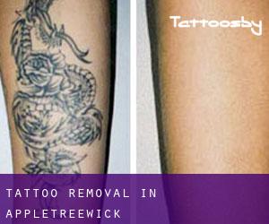 Tattoo Removal in Appletreewick