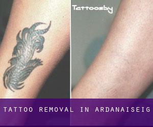 Tattoo Removal in Ardanaiseig
