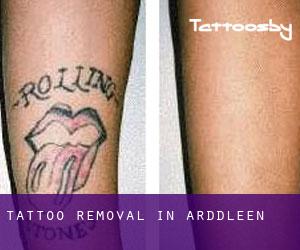 Tattoo Removal in Arddleen