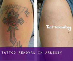 Tattoo Removal in Arnesby