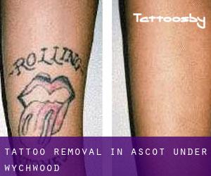 Tattoo Removal in Ascot under Wychwood