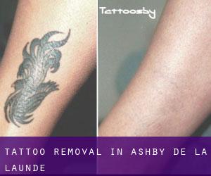 Tattoo Removal in Ashby de la Launde