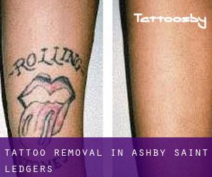Tattoo Removal in Ashby Saint Ledgers
