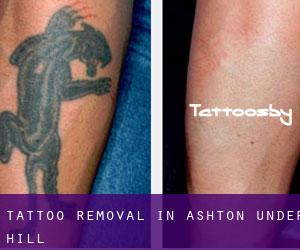 Tattoo Removal in Ashton under Hill