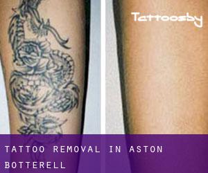 Tattoo Removal in Aston Botterell