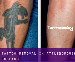 Tattoo Removal in Attleborough (England)
