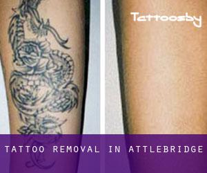 Tattoo Removal in Attlebridge