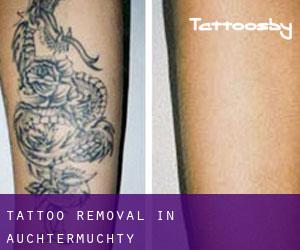 Tattoo Removal in Auchtermuchty