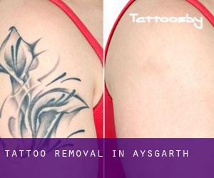 Tattoo Removal in Aysgarth