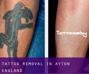 Tattoo Removal in Ayton (England)