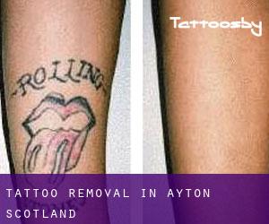 Tattoo Removal in Ayton (Scotland)