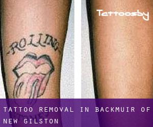 Tattoo Removal in Backmuir of New Gilston