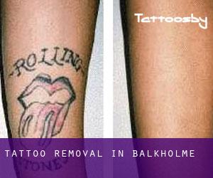 Tattoo Removal in Balkholme