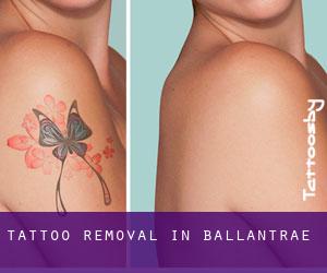 Tattoo Removal in Ballantrae
