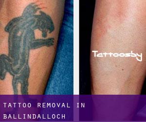 Tattoo Removal in Ballindalloch