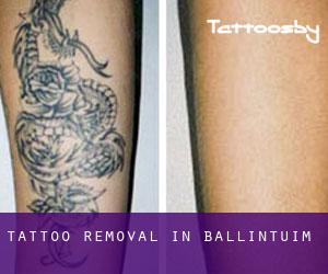 Tattoo Removal in Ballintuim