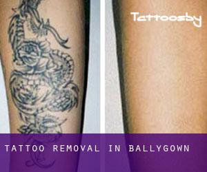 Tattoo Removal in Ballygown