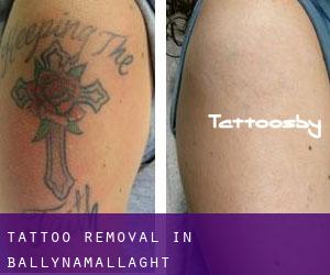 Tattoo Removal in Ballynamallaght
