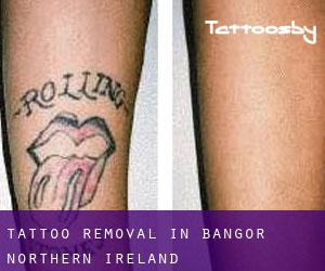 Tattoo Removal in Bangor (Northern Ireland)