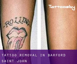 Tattoo Removal in Barford Saint John
