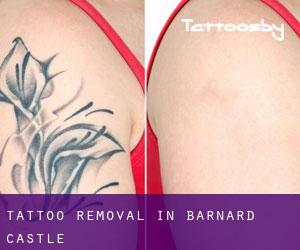 Tattoo Removal in Barnard Castle