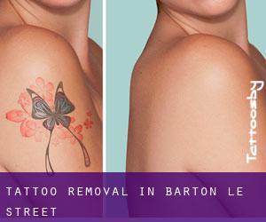 Tattoo Removal in Barton le Street